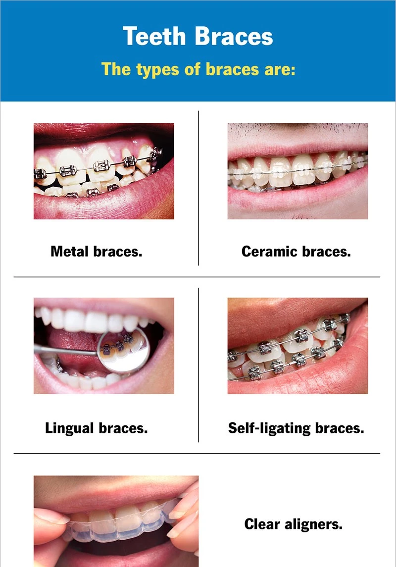 Diagram comparing types of braces and clear aligners