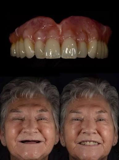 Complete dentures and smile comparison