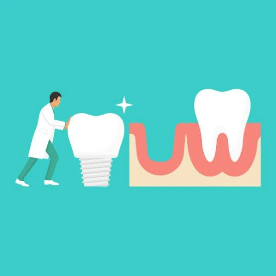 Dental implant and natural tooth illustration