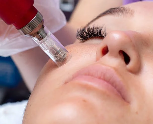 Microneedling treatment on facial skin