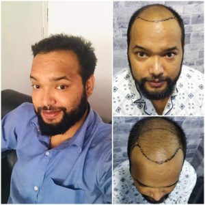 Hair Transplant